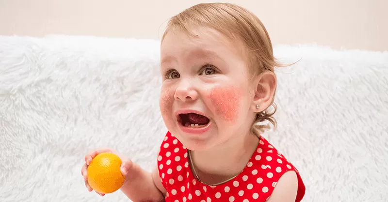 cac-benh-di-ung-hay-gap-o-tre